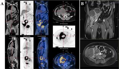 Case Report: Complete Response to Antiangiogenesis and Immune Checkpoint Blockade in an Unresectable MMR-Deficient Leiomyosarcoma Harboring Biallelic Loss of PTEN